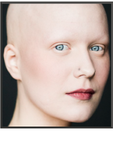 alopecia universalis treatment 2013