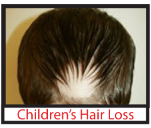 Children's Hair Loss
